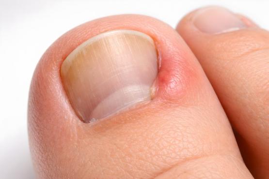Ongle incarné Ongle incarné