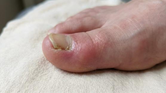 Ongles incarné Ongles incarné