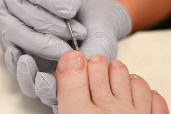 Pédicure médicale Pédicure médicale