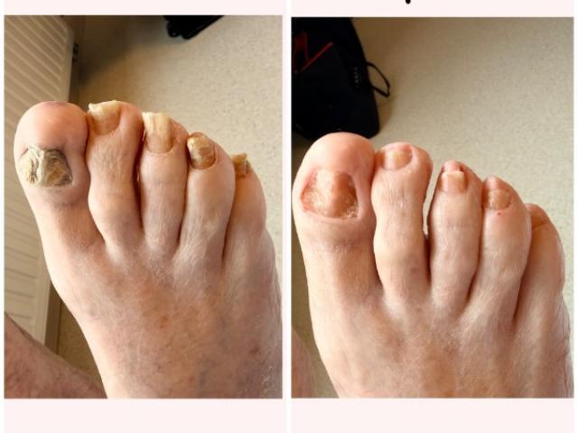 Traitement de mycose de l'ongle