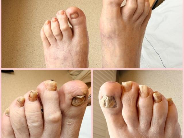 Traitement de mycose de l'ongle
