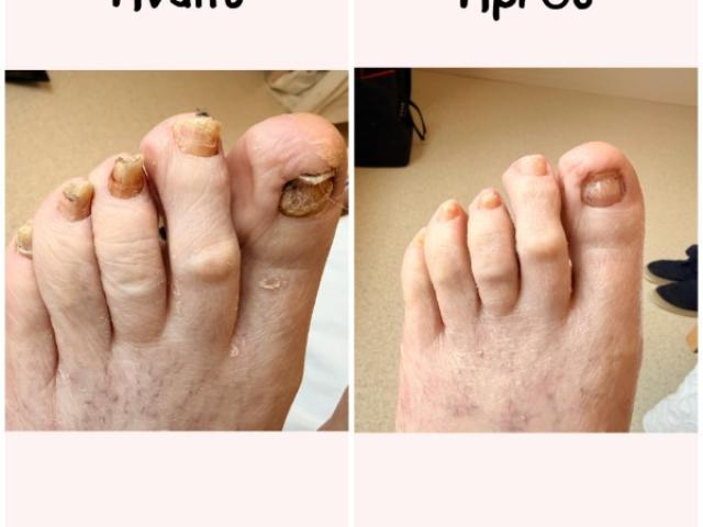 Traitement de mycose de l'ongle