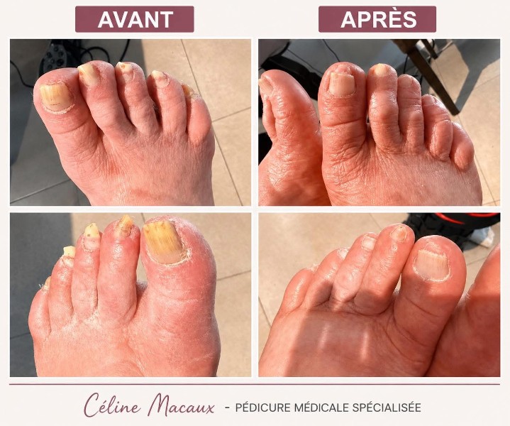 Ongles épaissis et déformés