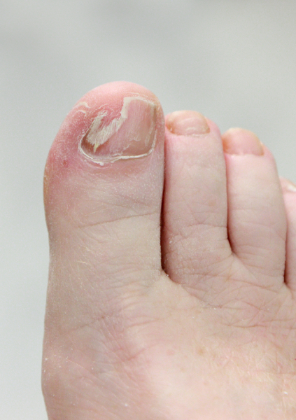 Reconstruction d’ongle